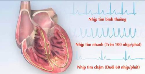 dấu hiệu nhận biết bạn đã bị ảnh hưởng đến tim mạch do covid-19